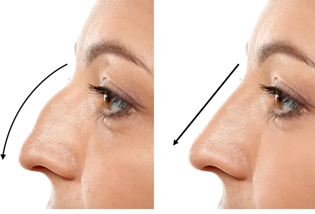 avant-apres-rhinoplastie-tunisie