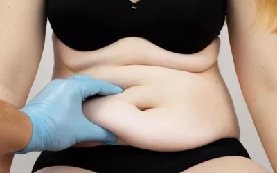 5 avantages pratiques de l’abdominoplastie