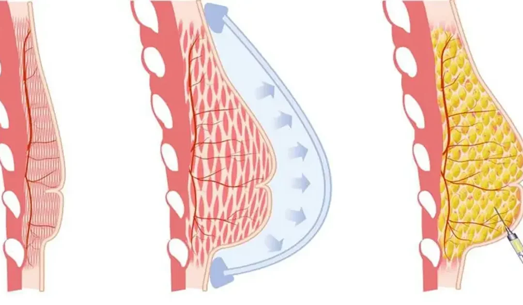 Lipofilling mammaire : les facteurs pouvant affecter le résultat