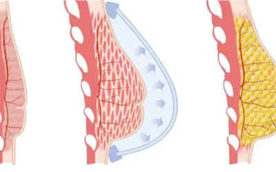 Lipofilling mammaire : les facteurs pouvant affecter le résultat