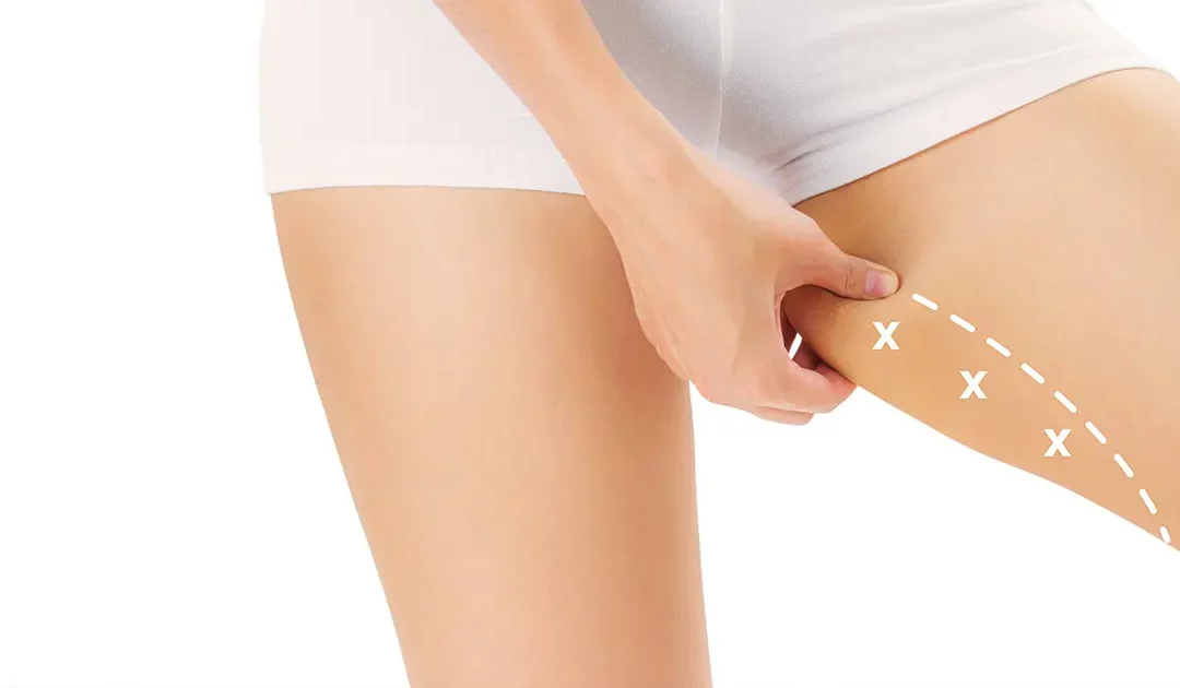 Quel traitement esthétique réaliser pour avoir un Thigh Gap ?